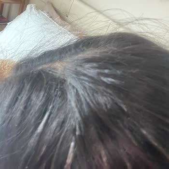 Ali Gür Selamiçeşme Saç Kaynak İşlemi Deneyimim