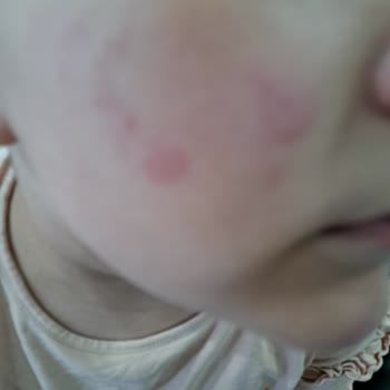 Mustela 8 Yaşında Kızımın Yüzünde Alerjiye Neden Oldu
