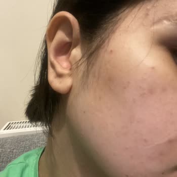 Cerave Yüz Yıkama Jeli Kullandım Yüzüm Komedonla Doldu