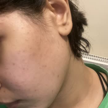 Cerave Yüz Yıkama Jeli Kullandım Yüzüm Komedonla Doldu