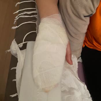 Porsi10 Gurme Cheddarlı Patates Topları'ndan Kaynaklı Yüz Ve El Yaralanması