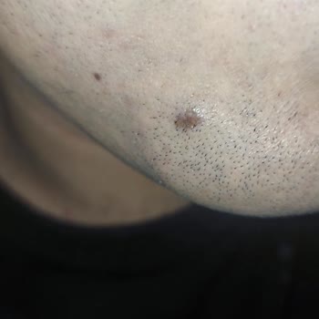 Quartz Clinique Ben Alma İşini Becerememe Üzerine Ücret Talep Etme