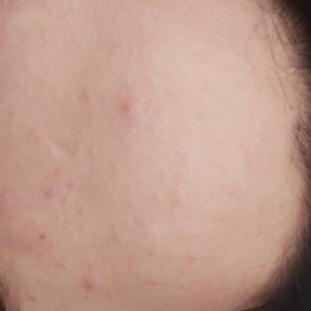 Neutrogena Sivilce Karşıtı Yağsız Yüz Nemlendiricisi Kullanımı Sonrası Cilt Problemi