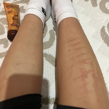 Zeynep Meriç Beauty Epilasyonda Vücudumu Yaktılar