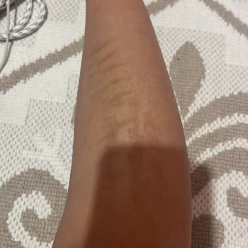 Zeynep Meriç Beauty Epilasyonda Vücudumu Yaktılar