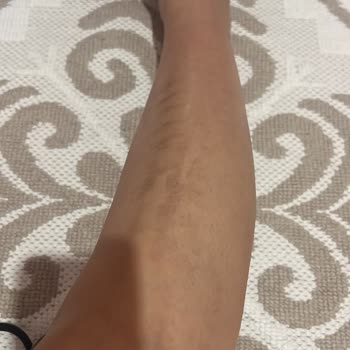 Zeynep Meriç Beauty Epilasyonda Vücudumu Yaktılar