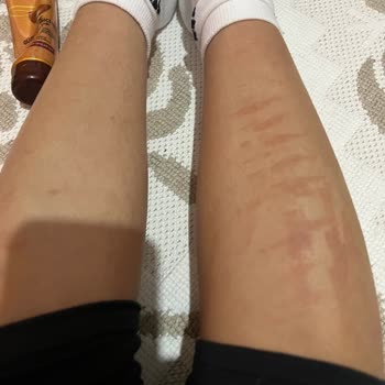 Zeynep Meriç Beauty Epilasyonda Vücudumu Yaktılar