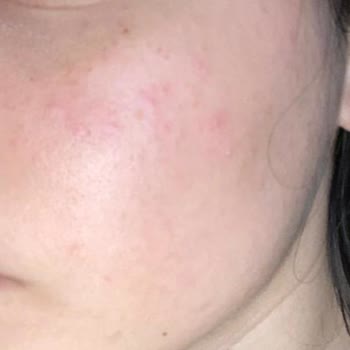 Sinoz Güneş Kremi'nden Kaynaklı Sivilce Sorunu