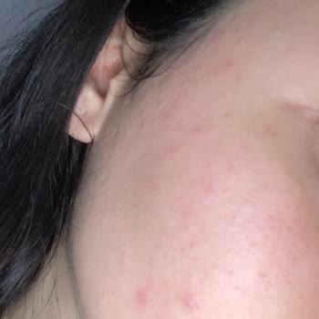 Sinoz Güneş Kremi'nden Kaynaklı Sivilce Sorunu