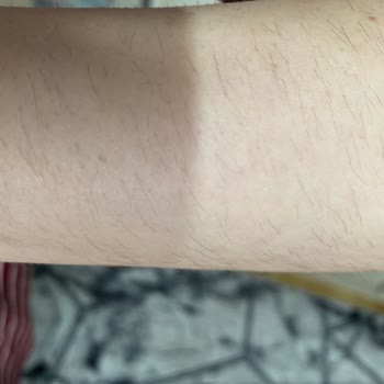 Sevgi Medlife Estetik Ankara Lazer Memnuniyetsizliği