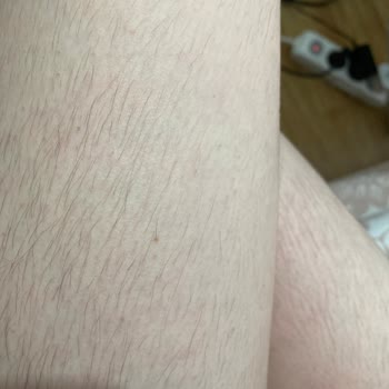 Sevgi Medlife Estetik Ankara Lazer Memnuniyetsizliği