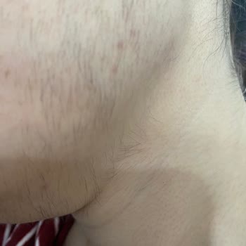 Sevgi Medlife Estetik Ankara Lazer Memnuniyetsizliği