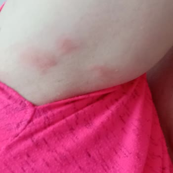 Gliss İntense Therapy Şampuan Alerjik Reaksiyon Gösterdi