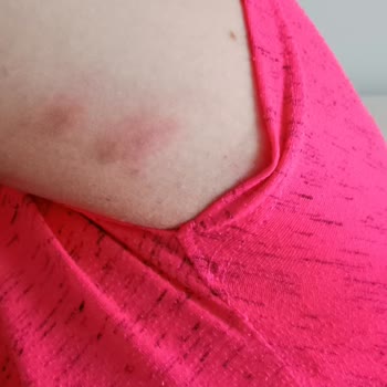 Gliss İntense Therapy Şampuan Alerjik Reaksiyon Gösterdi