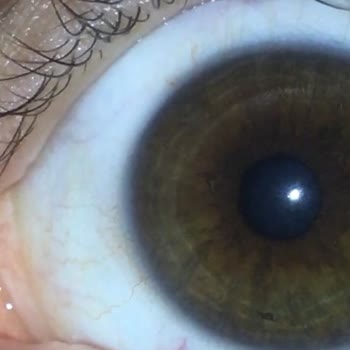 Hypnose Lens Gözüme Mikrop Kaptırdı!