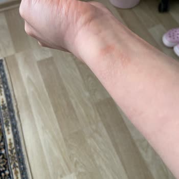 Apple Watch 7 Alerji