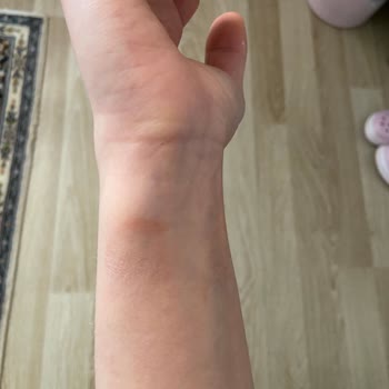 Apple Watch 7 Alerji