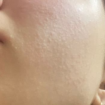 Nivea Yüz Yıkama Köpüğü Yüzümü Kızarttı!