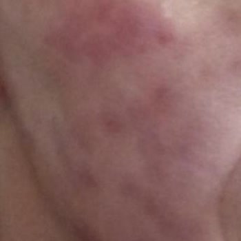 Elos Lazer Güzellik Ve Sağlık Memnuniyetsizlik