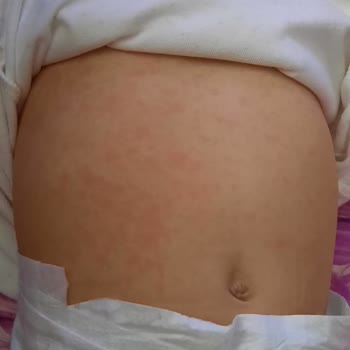 Özel Bilge Hastanesi Yanlış Tedavi Uygulandı