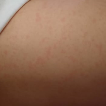 Özel Bilge Hastanesi Yanlış Tedavi Uygulandı