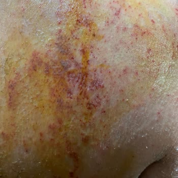 Bioder Deri Tahrişi Alerji