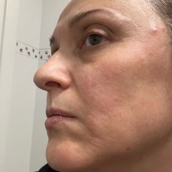 Lancome Serum Yüzümü Yaktı