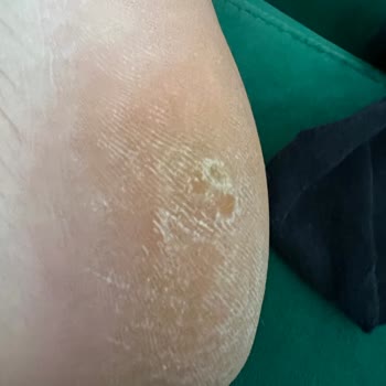 Derimod Mağazasından Aldığım Ayakkabı Ayağımı Rahatsız Etti