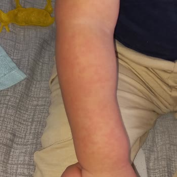 Uni Baby Şampuan Alerji Yapıyor