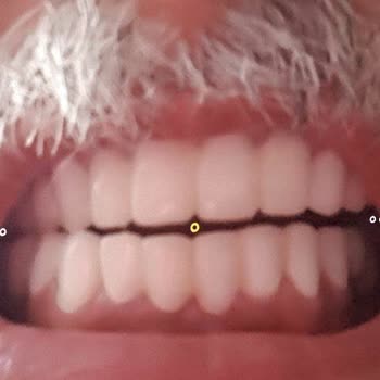 Dentanorm Dental İmplant İşlemimde Yaşadığım Sorunlar