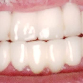 Dentanorm Dental İmplant İşlemimde Yaşadığım Sorunlar