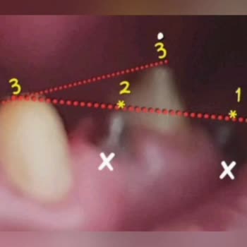Dentanorm Dental İmplant İşlemimde Yaşadığım Sorunlar