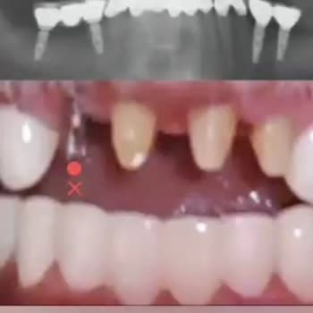 Dentanorm Dental İmplant İşlemimde Yaşadığım Sorunlar