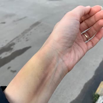 Liv Hospital Damar Yolu Açmaya Gelen Kişi Çok Deneyimsizdi!