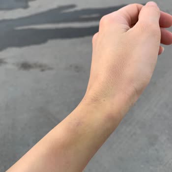 Liv Hospital Damar Yolu Açmaya Gelen Kişi Çok Deneyimsizdi!