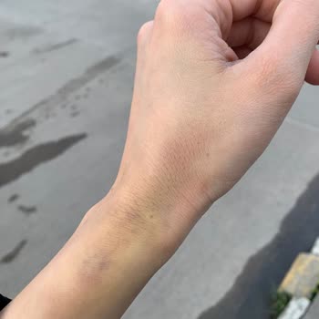 Liv Hospital Damar Yolu Açmaya Gelen Kişi Çok Deneyimsizdi!