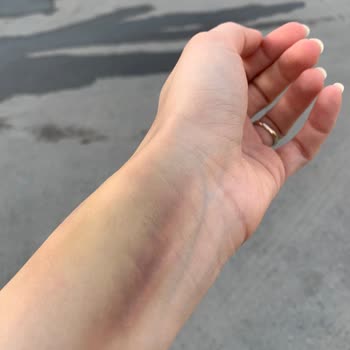 Liv Hospital Damar Yolu Açmaya Gelen Kişi Çok Deneyimsizdi!