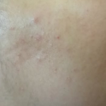 Diadermine Makyaj Temizleme Suyu Cildimi Mahvetti