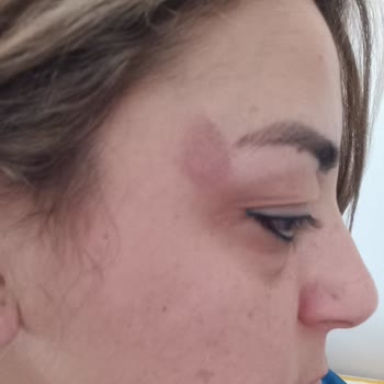 Hair Fbi Taktıkları Saçlar Yoğun Bir Şekilde Döküldü Ve Yüzümü Yaktılar