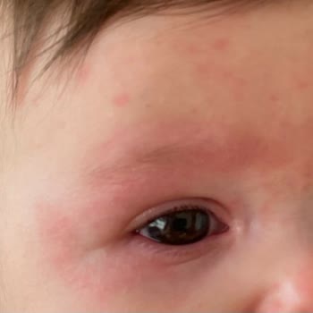 Bioderma Abcderm Foaming Şampuan Bebeğimi Kıpkırmızı Ve Benek Benek Yaptı