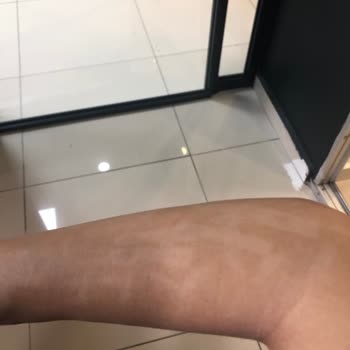 La Joie Beauty & Aesthetic Lazer İşleminde Kolum Yandı