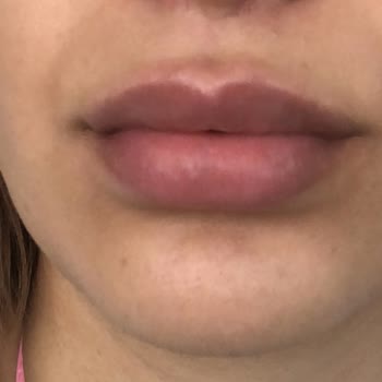 Şeyda Zaloğlu Beauty'de Dudak Dolgusu Yetersiz