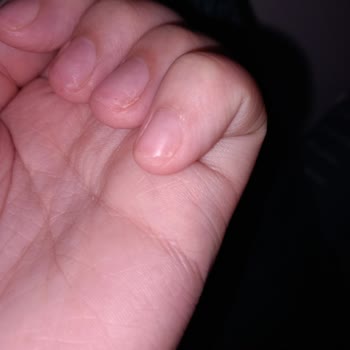 Aymira Koçaklı Yaşam Merkezi'nde Protez Tırnak Pişmanlığı