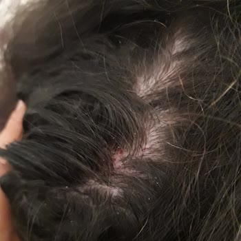 DP Şampuan Kepek, Kaşıntı Ve Yara Yaptı.