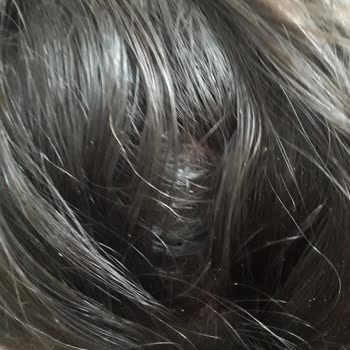 DP Şampuan Kepek, Kaşıntı Ve Yara Yaptı.