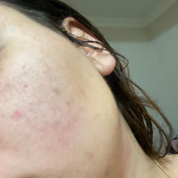 Cire Aseptine Yüz Güneş Koruyucu 50+ Yüzümün Her Yerini Yara Yaptı.