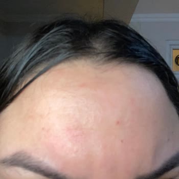 Cire Aseptine Yüz Güneş Koruyucu 50+ Yüzümün Her Yerini Yara Yaptı.