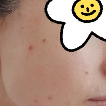 Missha Güneş Kremi Sivilce Yaptı