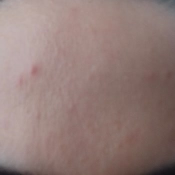 Missha Güneş Kremi Sivilce Yaptı