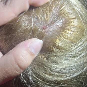 Palette Saç Derisi Yanması Kimyasal